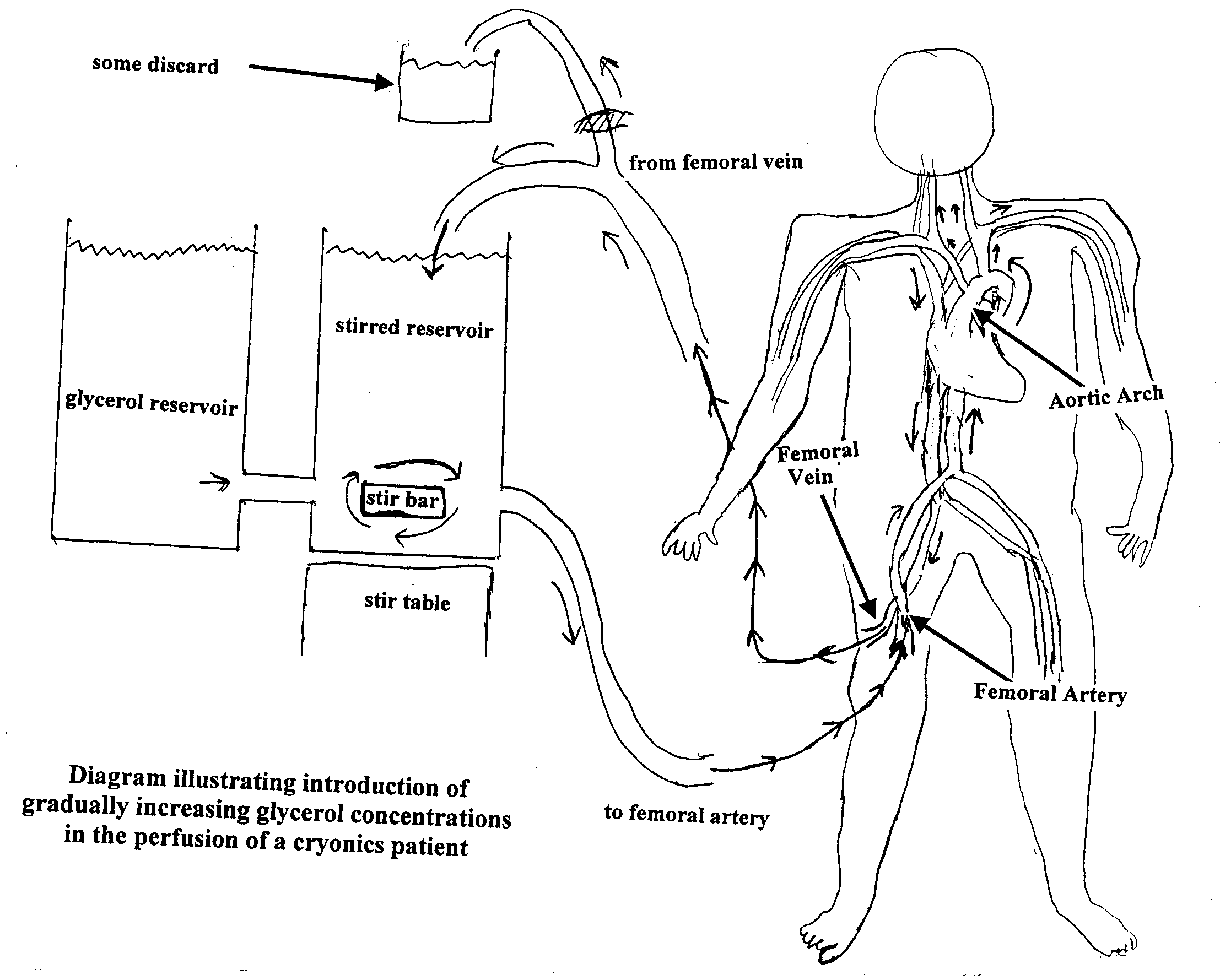 [ Closed Circuit Perfusion of a Cryonics Patient ]