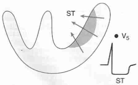 [ Subendocardial ischemia<br>ST−segment depression ]